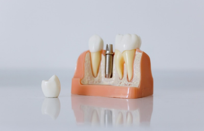 Anatomical dental model illustrating a titanium dental implant post and crown embedded in jaw bone.