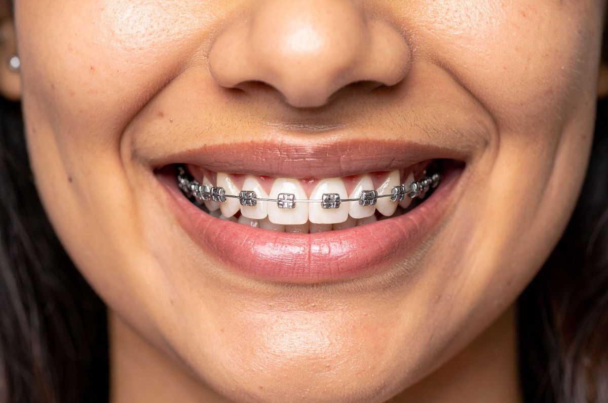Braces & Clear Aligners