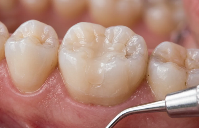 Close-up of a tooth-coloured filling on a back tooth